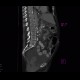 Chronic pancreatitis, calcified, nasojejunal tube: CT - Computed tomography