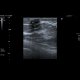 Calcifications in breast: US - Ultrasound