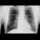 Calcified lymph node in lung hilum: X-ray - Plain radiograph