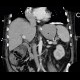 Pachypleuritis, calcified, pachypleuritis calcarea: CT - Computed tomography