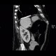 Pachypleuritis, calcified, pachypleuritis calcarea: CT - Computed tomography