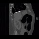 Pachypleuritis, calcified, pachypleuritis calcarea: CT - Computed tomography