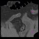 Carcinoid of small bowel: CT - Computed tomography