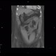 Carcinoid of small bowel: CT - Computed tomography