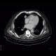 Carcinoid of the lung: CT - Computed tomography