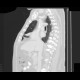 Carcinoid of the lung: CT - Computed tomography