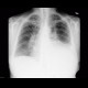 Pulmonary carcinosis: X-ray - Plain radiograph