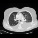 Lymphangitic carcinomatosis, fluidothorax: CT - Computed tomography