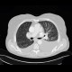 Pulmonary carcinosis: CT - Computed tomography