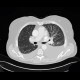 Lymphangitic carcinomatosis, fluidothorax: CT - Computed tomography