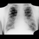 Lung metastases, cavitated metastases, bladder carcinoma: X-ray - Plain radiograph