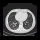 Lung metastases, cavitated metastases, bladder carcinoma: CT - Computed tomography