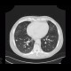 Lung metastases, cavitated metastases, bladder carcinoma: CT - Computed tomography