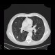 Lung metastases, cavitated metastases, bladder carcinoma: CT - Computed tomography