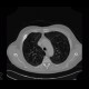 Lung metastases, cavitated metastases, bladder carcinoma: CT - Computed tomography