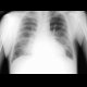Interstitial edema of the lung, Kerley B lines: X-ray - Plain radiograph