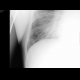 Interstitial edema of the lung, Kerley B lines: X-ray - Plain radiograph