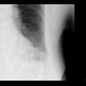 Kerley lines B: X-ray - Plain radiograph