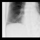 Kerley lines B: X-ray - Plain radiograph