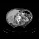 Renal cell carcinoma: CT - Computed tomography