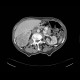 Renal cell carcinoma: CT - Computed tomography