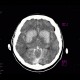 Coagulation necrosis of basal ganglia: CT - Computed tomography