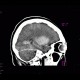 Coagulation necrosis of basal ganglia: CT - Computed tomography