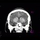 Coagulation necrosis of basal ganglia: CT - Computed tomography