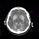 Coagulation necrosis of basal ganglia: CT - Computed tomography