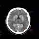 Coagulation necrosis of basal ganglia: CT - Computed tomography