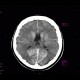 Coagulation necrosis of basal ganglia: CT - Computed tomography