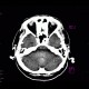 Coagulation necrosis of basal ganglia: CT - Computed tomography