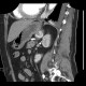 Collision tumour, adrenal gland, myelolipoma, metastasis: CT - Computed tomography