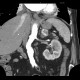 Collision tumour, adrenal gland, myelolipoma, metastasis: CT - Computed tomography