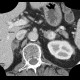 Collision tumour, adrenal gland, myelolipoma, metastasis: CT - Computed tomography
