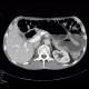 Ileocecal resection, Crohn's disease, CT enterography: CT - Computed tomography