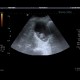 Complicated cyst, Bosniak III: US - Ultrasound