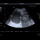 Complicated cyst, Bosniak III: US - Ultrasound