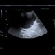 Complicated cyst, Bosniak III: US - Ultrasound