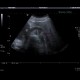 Complicated cyst, Bosniak III: US - Ultrasound