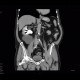 Complicated cyst, Bosniak III: US - Ultrasound