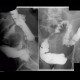 Compression of sigmoid colon: RF - Fluoroscopy