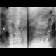 Compression fracture of lumbar vertebra: X-ray - Plain radiograph