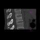 Compression fracture of lumbar vertebra: CT - Computed tomography