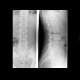 Compression fracture of lumbar vertebra: X-ray - Plain radiograph