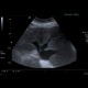 Congestive hepatopathy, biphasic flow in portal vein: US - Ultrasound