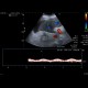 Congestive hepatopathy, biphasic flow in portal vein: US - Ultrasound