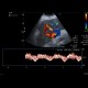 Congestive hepatopathy, biphasic flow in portal vein: US - Ultrasound