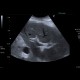 Congestive hepatopathy, biphasic flow in portal vein: US - Ultrasound