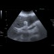 Congestive hepatopathy, biphasic flow in portal vein: US - Ultrasound